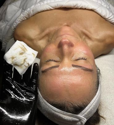 Dermaplaning facial