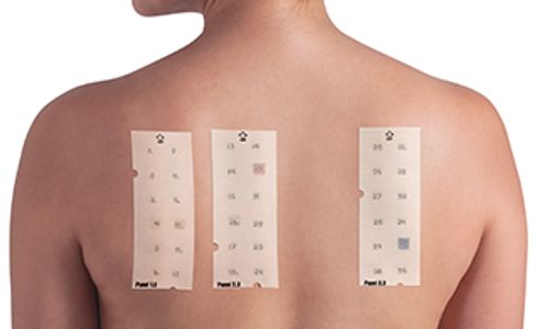 Patch test for skin allergy or contact dermatitis