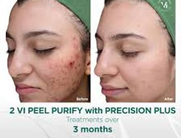 VI Peel Purify Precision Plus + Peptides before and after treatment being performed at IV Beauty Bar