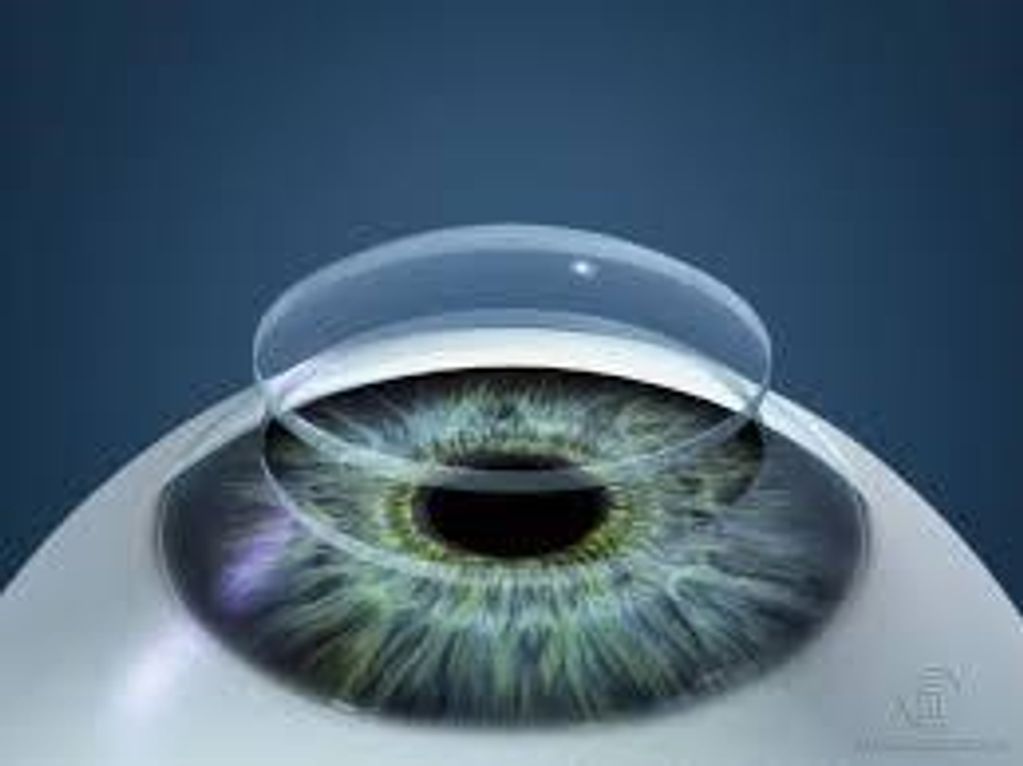 Femto-laser corneal transplant