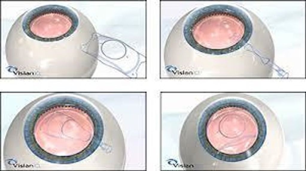 Intra-occular contact lens 