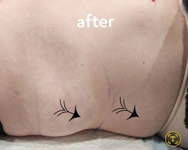 After Manual lymphatic drainage. Significant decrease in swelling in just 1 hour and 1 treatment.