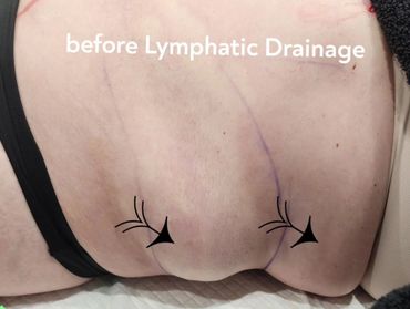 Before Manual lymphatic drainage. Client had abdominal liposuction done.