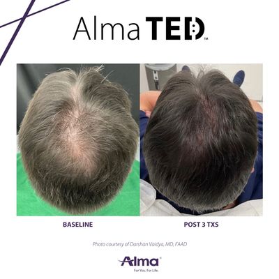 The FDA approved Alma TED device is a non-invasive, painless hairloss treatment for men and women.