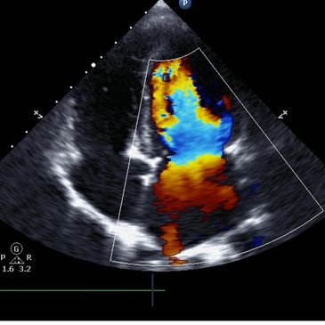 Echocardiogram
