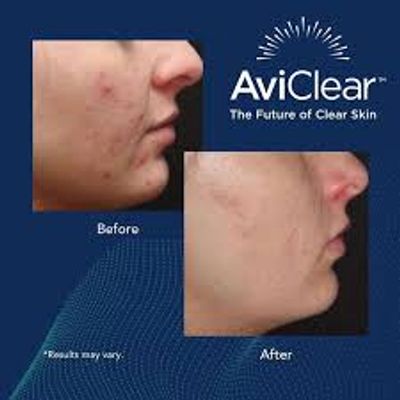 AviClear is your acne treatment of choice available at Integrity Medical and Aesthetics