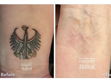 Remove your tattoo at Integrity Medical and Aesthetics