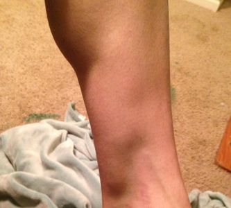Felicia's leg with Compartment Syndrome 'bulge' 2 days before surgery.
