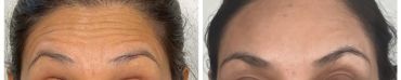 Before and after images showing reduced forehead wrinkles.