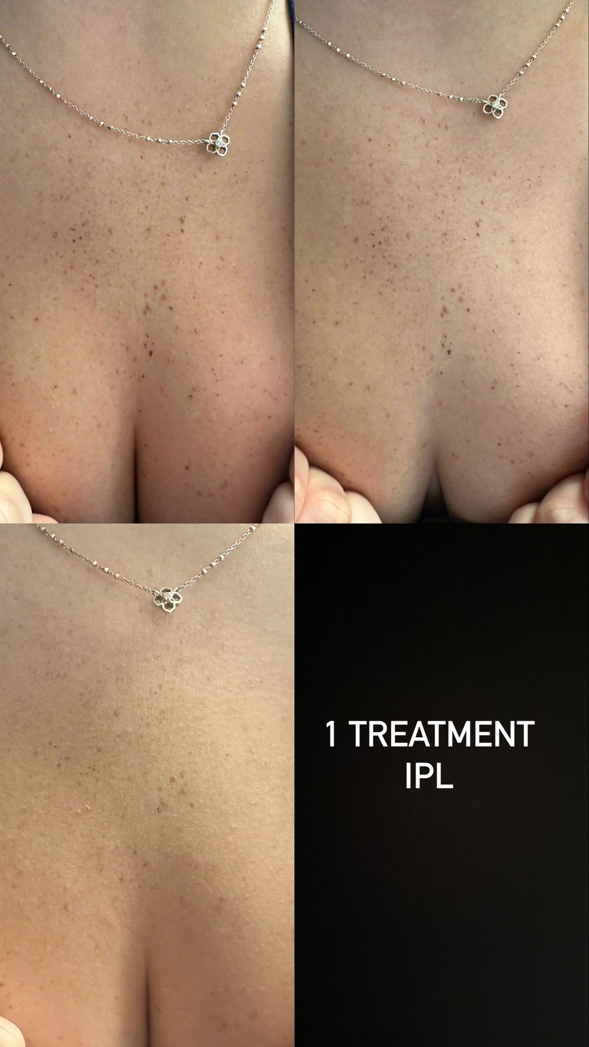Before and after photos showing skin improvement after one IPL treatment.