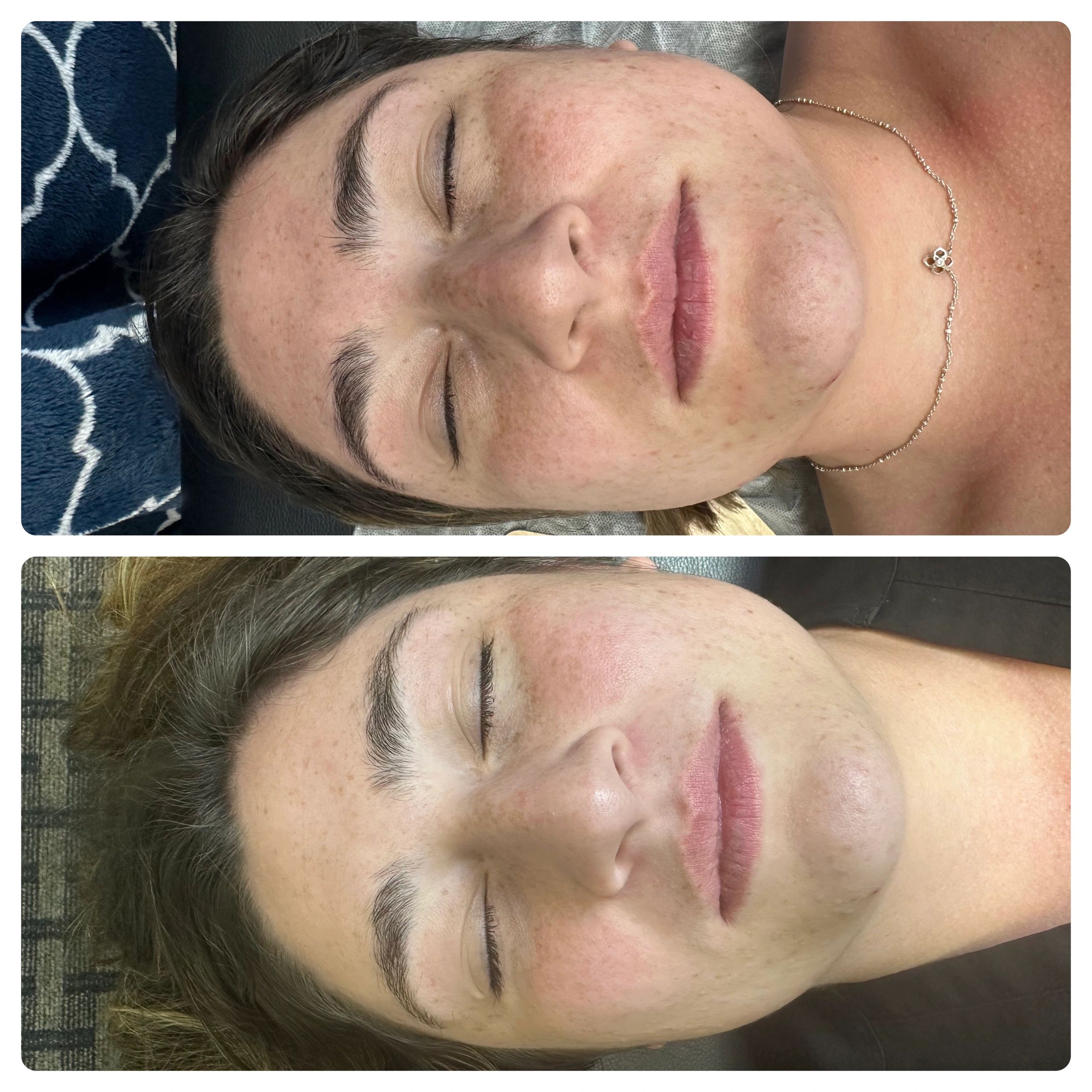 Before and after facial skin treatment showing reduced redness and smoother texture.