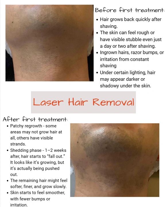 Before and after laser hair removal treatment showing skin and hair changes.