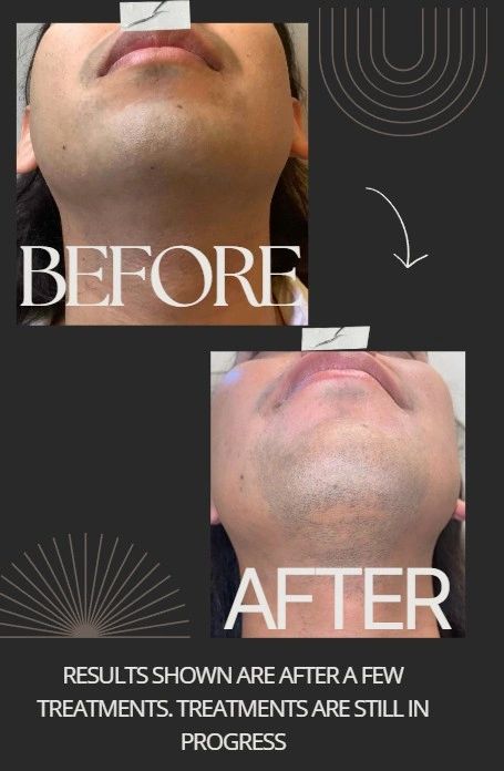 Before and after photos showing treatment progress on a man's chin and jawline.