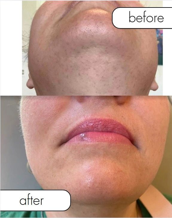 Before and after facial hair removal on the chin area.
