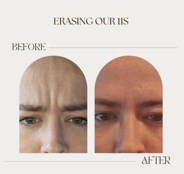 Before and after photos showing reduced forehead wrinkles called '11s'.