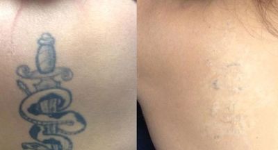 Client photo Tattoo before and after fading.