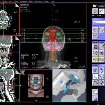 A radiotherapy plan of a head and neck treatment