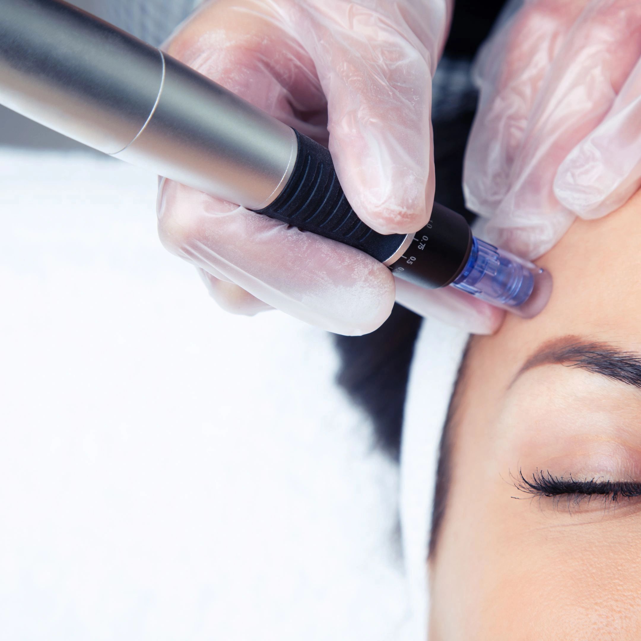 Medical-grade microneedling treatment at NATIV Aesthetics & Co., a leading Centennial medspa
