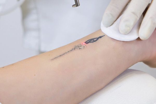 laser tattoo removal training near me, level 5 laser tattoo removal training, laser training, cpd