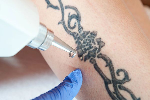 laser tattoo removal training near me, level 5 laser tattoo removal training, laser training, cpd