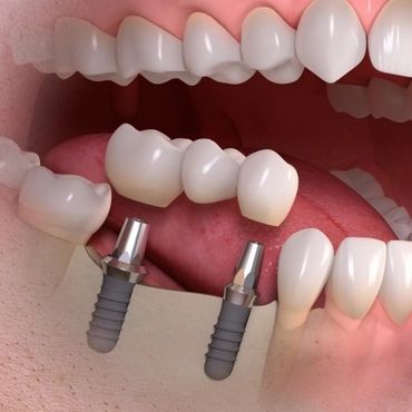 Private Dental Implants in Carmarthen