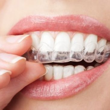 Invisalign Tooth Straightening Carmarthen West Wales