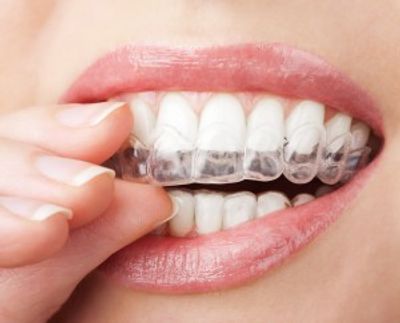 Invisible Braces for Adults in Carmarthen