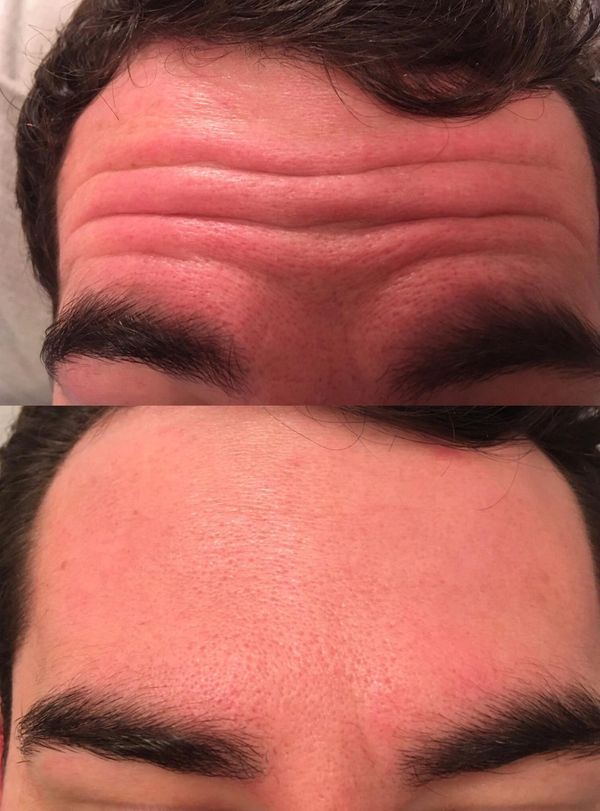 Before and After - anti-wrinkle injections