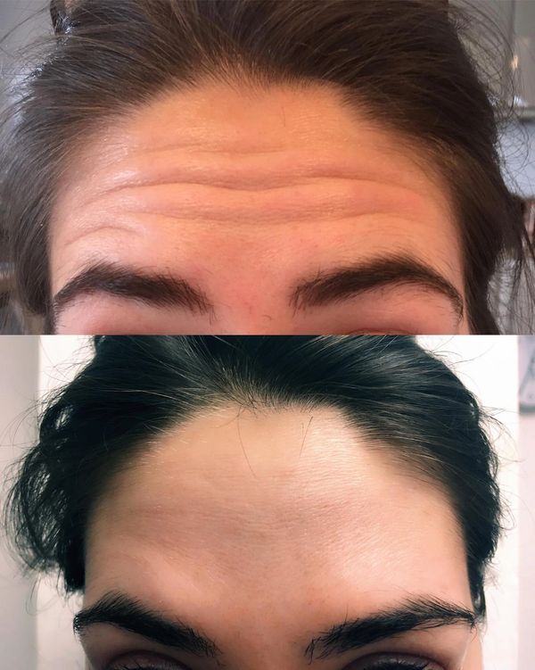 Before and After - anti-wrinkle injections