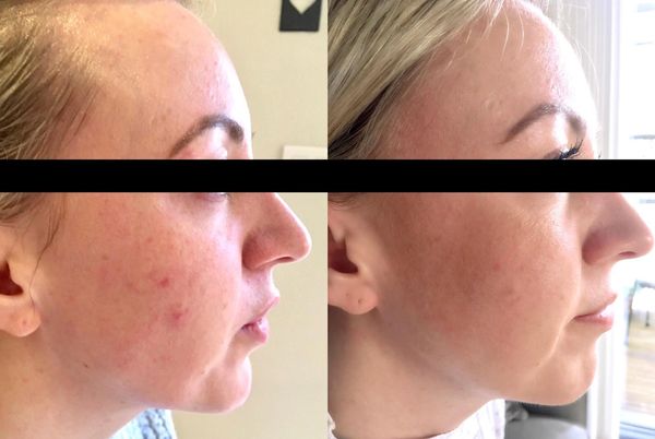Before & After - chemical peel