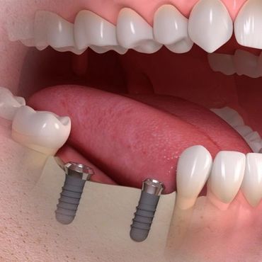 Dental Implants in Carmarthenshire West Wales