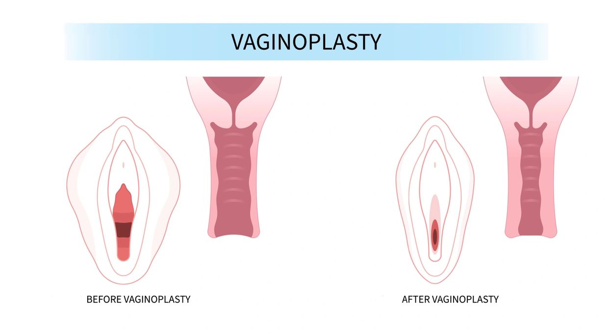 Vaginoplasty before and after drawing.