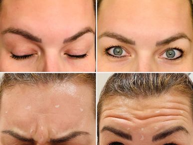 Why have lines and wrinkles when you don't have to! Jeuveau neurotoxin used here.