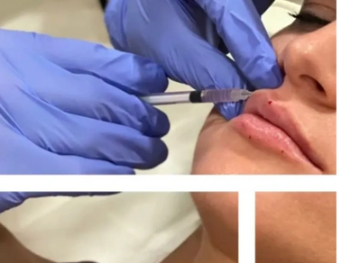 Dermal Filler for lips is a must to improve the plump hydrated appearance we lack.
