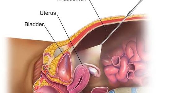 For Uterus Ovary & Tube Disorders
Minimally Invasive Technique for Better Diagnosis Better Treatment