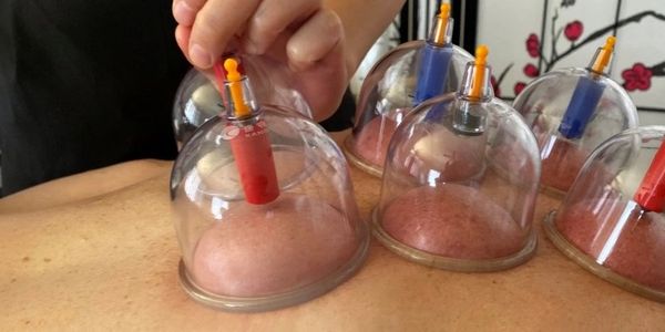 Cupping massage therapy has numerous benefits for  pain management, Migraine headache relief