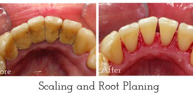 Before and After SRP