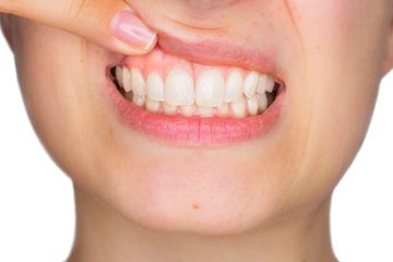Gum Reshaping | Gum Countouring | Tooth Lengthening | West Hartford Dentist | New Britain CT