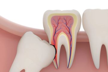 Wisdom Tooth | Impacted | Removal | Extraction | West Hartford | New Britain | Best | Dentist 