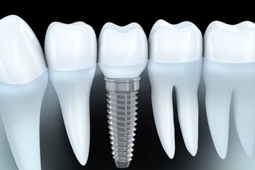 Dental Implants | Implant Dentist West Hartford, CT | New Britain, CT | Dentures on Implants