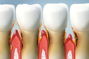 Gum Disease | Periodontitis | Gingivitis |West Hartford | New Britain | Best Dentist | Whitening