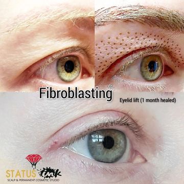 Plasma Lift also known as Fibroblast skin Tightening.