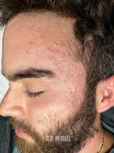Adult acne treatment by Angel Beauty Aesthetics