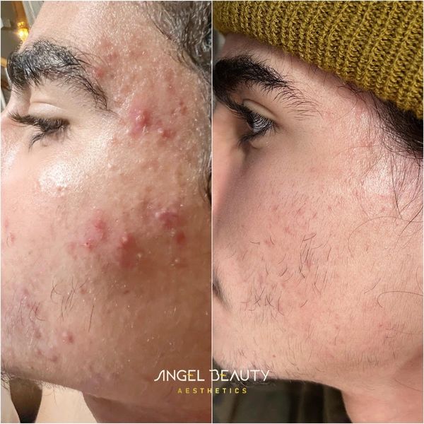 Acne bootcamp results