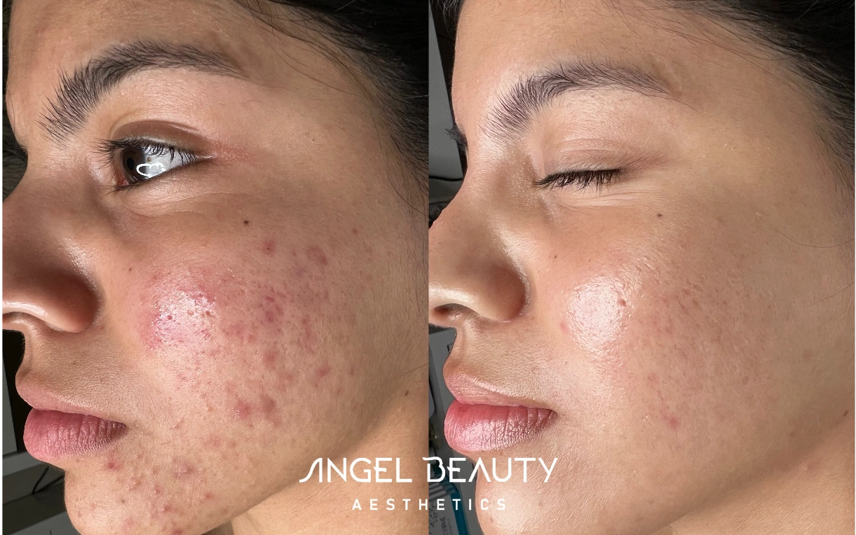 Angel Beauty Aesthetics Acne Program