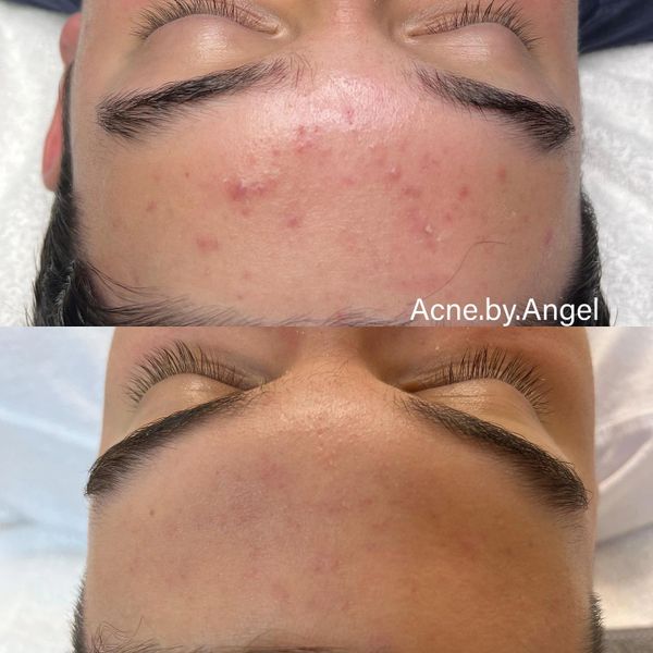 Teens acne treament