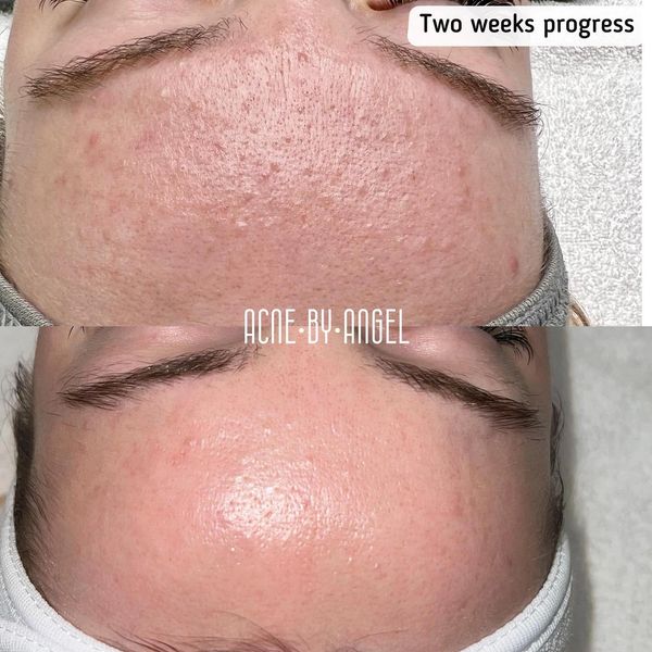 Acne maturation arrest results
