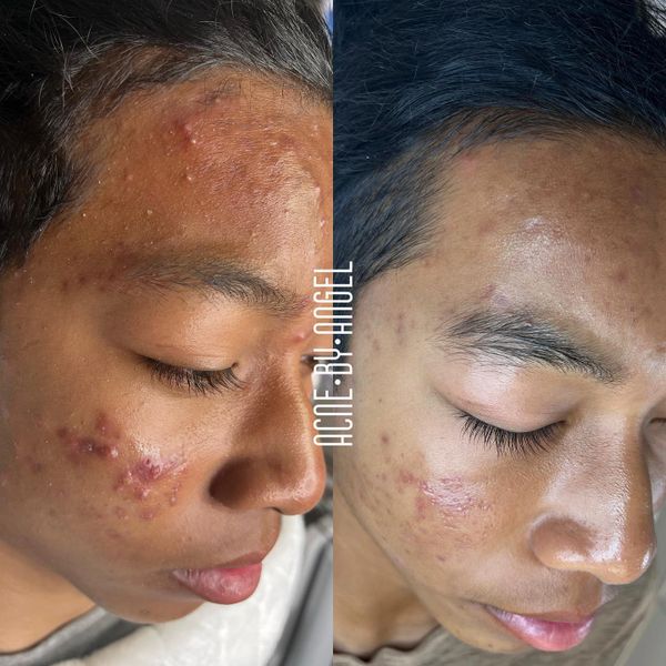 Acne Program