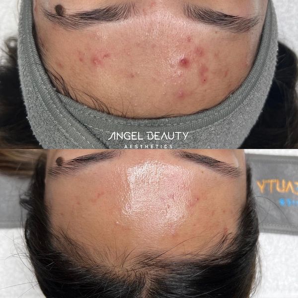 Customized acne treatment