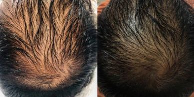 PRP hair loss treatment and hair restoration